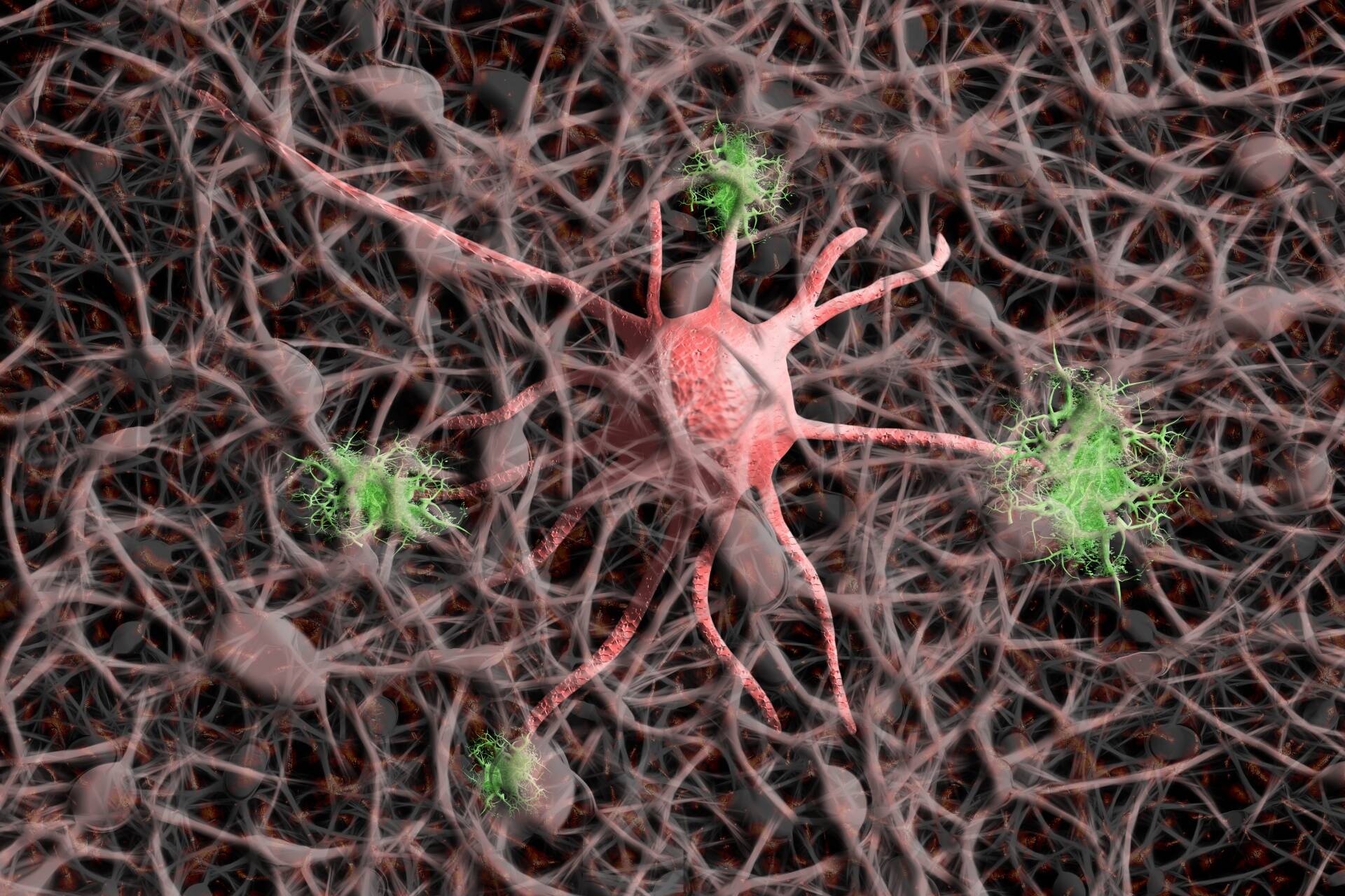 Immagine: alzheimer