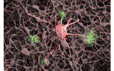 Immagine: alzheimer
